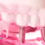 dental-implants-vs.-dentures_-making-the-right-choice