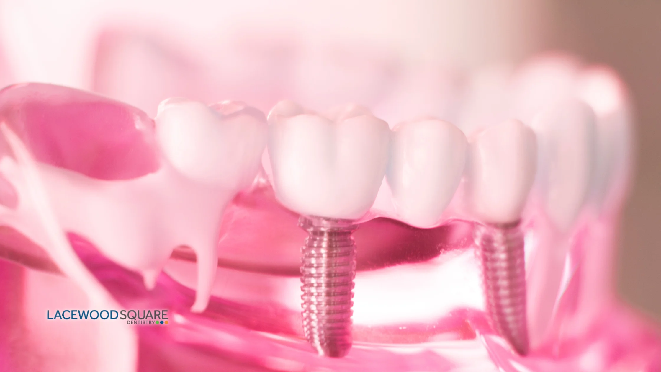 dental-implants-vs.-dentures_-making-the-right-choice